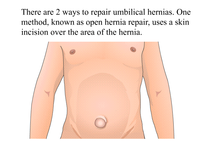 There are 2 ways to repair umbilical hernias. One method, known as open hernia repair, uses a skin incision over the area of the hernia.