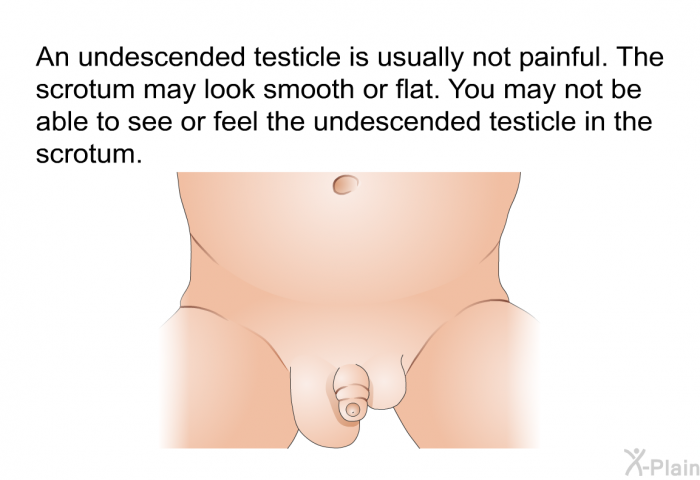 An undescended testicle is usually not painful. The scrotum may look smooth or flat. You may not be able to see or feel the undescended testicle in the scrotum.