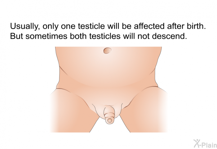 Usually, only one testicle will be affected after birth. But sometimes both testicles will not descend.