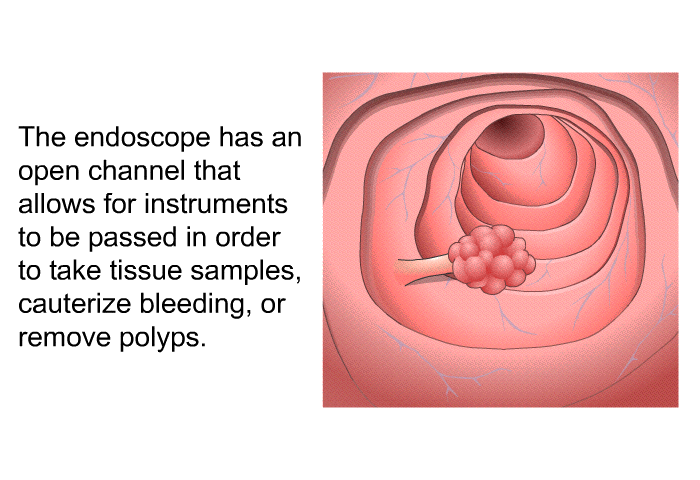 The endoscope has an open channel that allows for instruments to be passed in order to take tissue samples, cauterize bleeding, or remove polyps.