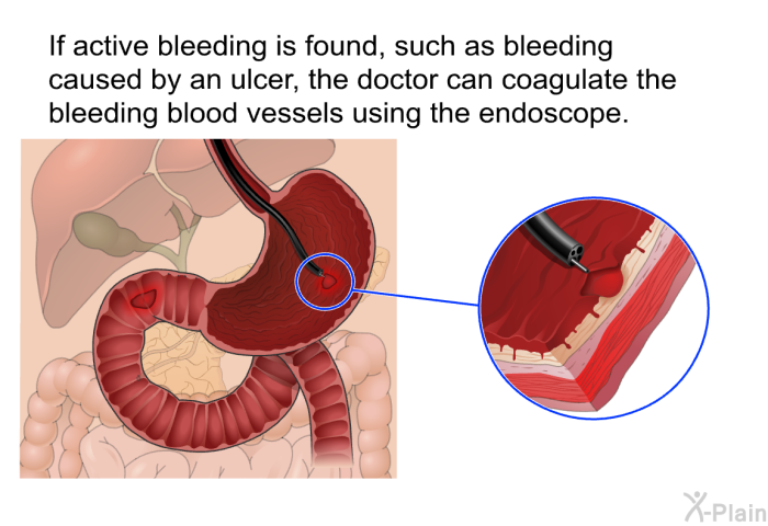 If active bleeding is found, such as bleeding caused by an ulcer, the doctor can coagulate the bleeding blood vessels using the endoscope.