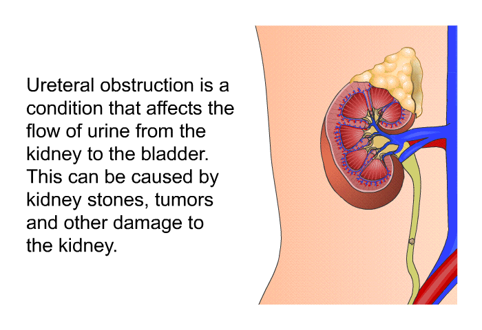 Ureteral obstruction is a condition that affects the flow of urine from the kidney to the bladder. This can be caused by kidney stones, tumors and other damage to the kidney.