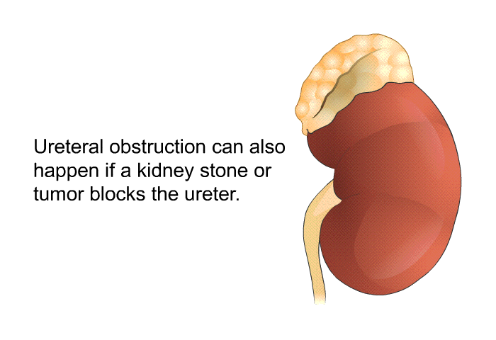 Ureteral obstruction can also happen if a kidney stone or tumor blocks the ureter.