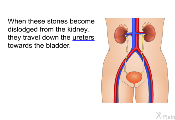 When these stones become dislodged from the kidney, they travel down the ureters towards the bladder.
