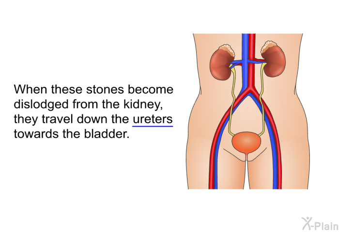 When these stones become dislodged from the kidney, they travel down the ureters towards the bladder.