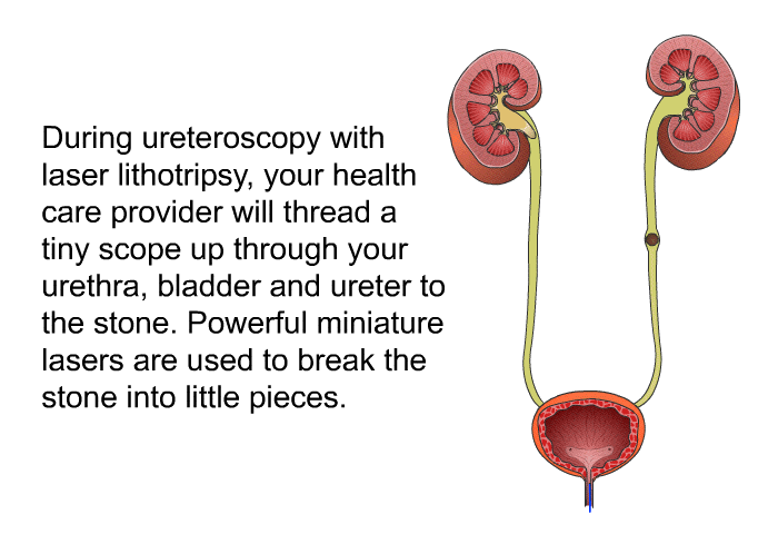 During ureteroscopy with laser lithotripsy, your health care provider will thread a tiny scope up through your urethra, bladder and ureter to the stone. Powerful miniature lasers are used to break the stone into little pieces.