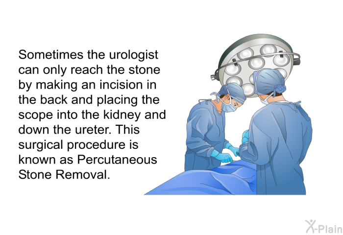 Sometimes the urologist can only reach the stone by making an incision in the back and placing the scope into the kidney and down the ureter. This surgical procedure is known as Percutaneous Stone Removal.