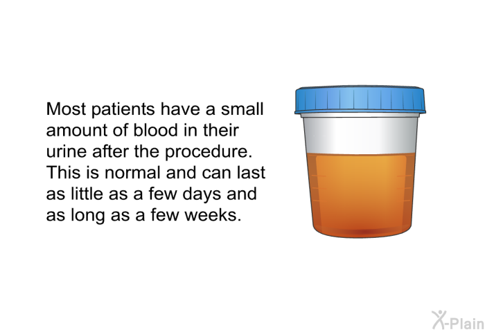 Most patients have a small amount of blood in their urine after the procedure. This is normal and can last as little as a few days and as long as a few weeks.