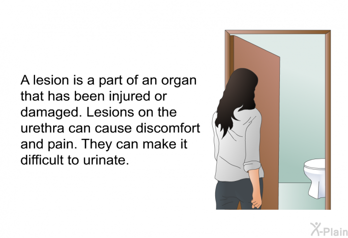 A lesion is a part of an organ that has been injured or damaged. Lesions on the urethra can cause discomfort and pain. They can make it difficult to urinate.
