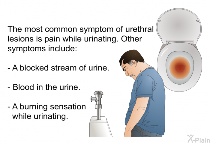 The most common symptom of urethral lesions is pain while urinating. Other symptoms include:  A blocked stream of urine. Blood in the urine. A burning sensation while urinating.