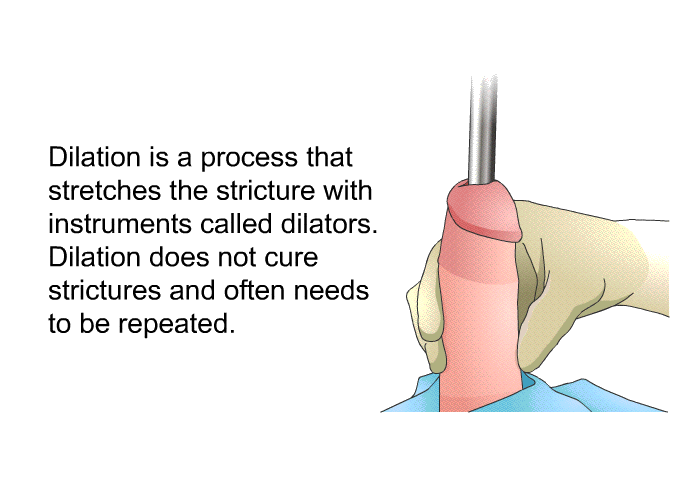 Dilation is a process that stretches the stricture with instruments called dilators. Dilation does not cure strictures and often needs to be repeated.