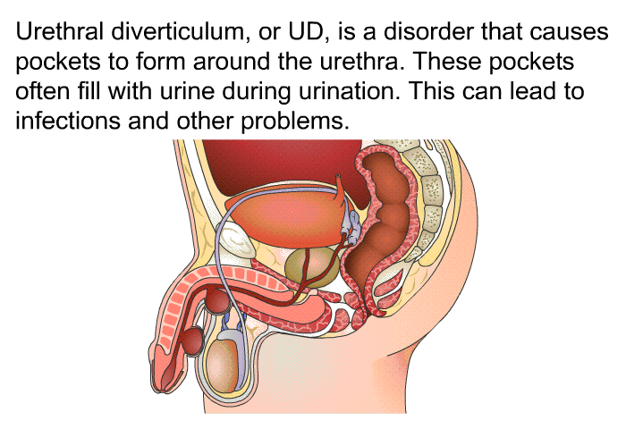 Urethral diverticulum, or UD, is a disorder that causes pockets to form around the urethra. These pockets often fill with urine during urination. This can lead to infections and other problems.