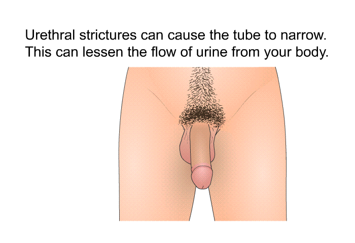 Urethral strictures can cause the tube to narrow. This can lessen the flow of urine from your body.
