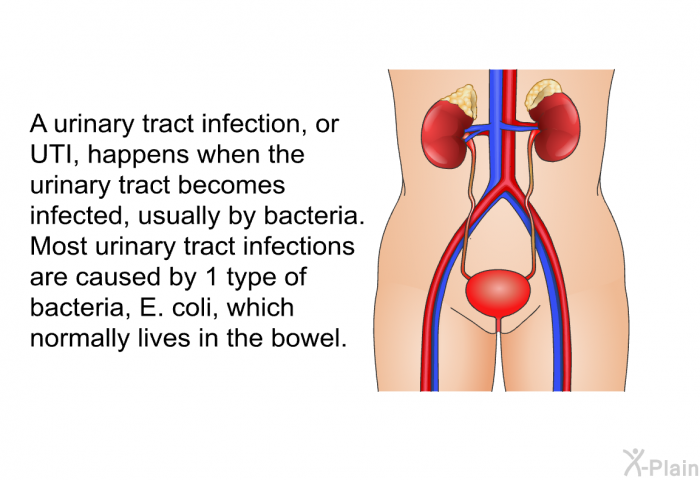A urinary tract infection, or UTI, happens when the urinary tract becomes infected, usually by bacteria. Most urinary tract infections are caused by 1 type of bacteria, E. coli, which normally lives in the bowel.
