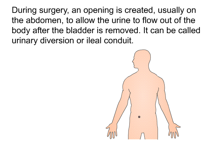 During surgery, an opening is created, usually on the abdomen, to allow the urine to flow out of the body after the bladder is removed. It can be called urinary diversion or ileal conduit.