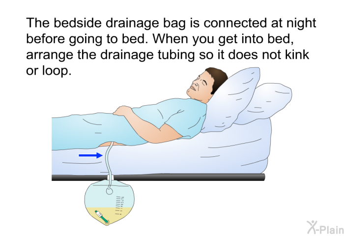 The bedside drainage bag is connected at night before going to bed. When you get into bed, arrange the drainage tubing so it does not kink or loop.