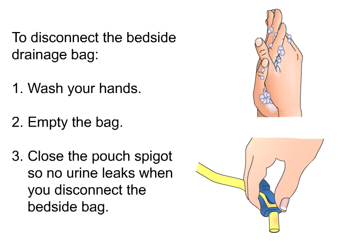 To disconnect the bedside drainage bag:  Wash your hands. Empty the bag. Close the pouch spigot so no urine leaks when you disconnect the bedside bag.