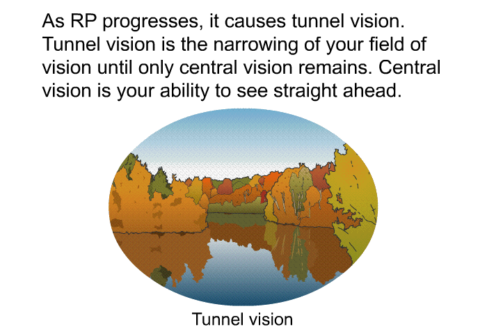 As RP progresses, it causes tunnel vision. Tunnel vision is the narrowing of your field of vision until only central vision remains. Central vision is your ability to see straight ahead.