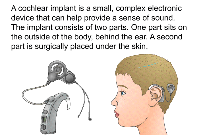 A cochlear implant is a small, complex electronic device that can help provide a sense of sound. The implant consists of two parts. One part sits on the outside of the body, behind the ear. A second part is surgically placed under the skin.