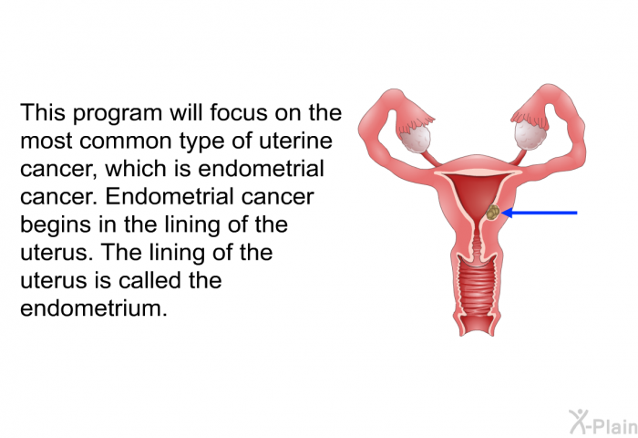 This health information will focus on the most common type of uterine cancer, which is endometrial cancer. Endometrial cancer begins in the lining of the uterus. The lining of the uterus is called the endometrium.