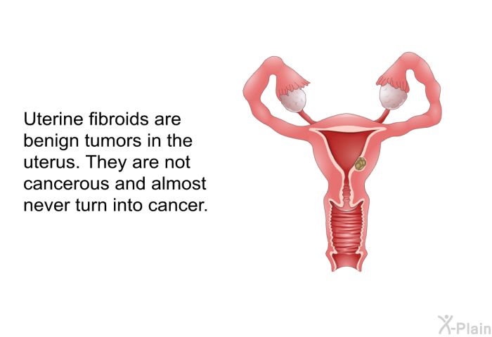 Uterine fibroids are benign tumors in the uterus. They are not cancerous and almost never turn into cancer.