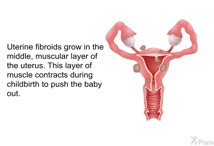 Uterine fibroids grow in the middle, muscular layer of the uterus. This layer of muscle contracts during childbirth to push the baby out.