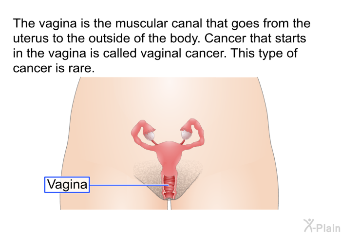 The vagina is the muscular canal that goes from the uterus to the outside of the body. Cancer that starts in the vagina is called vaginal cancer. This type of cancer is rare.