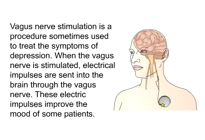 Vagus nerve stimulation is a procedure sometimes used to treat the symptoms of depression. When the vagus nerve is stimulated, electrical impulses are sent into the brain through the vagus nerve. These electric impulses improve the mood of some patients.