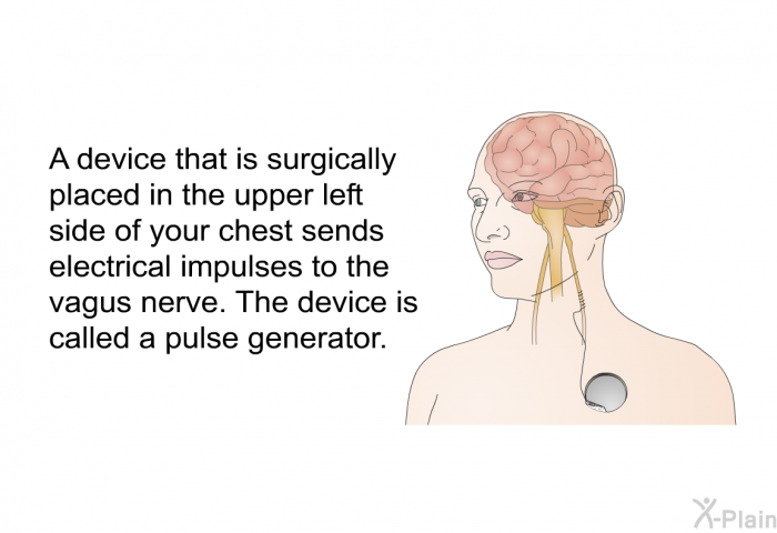 A device that is surgically placed in the upper left side of your chest sends electrical impulses to the vagus nerve. The device is called a pulse generator.