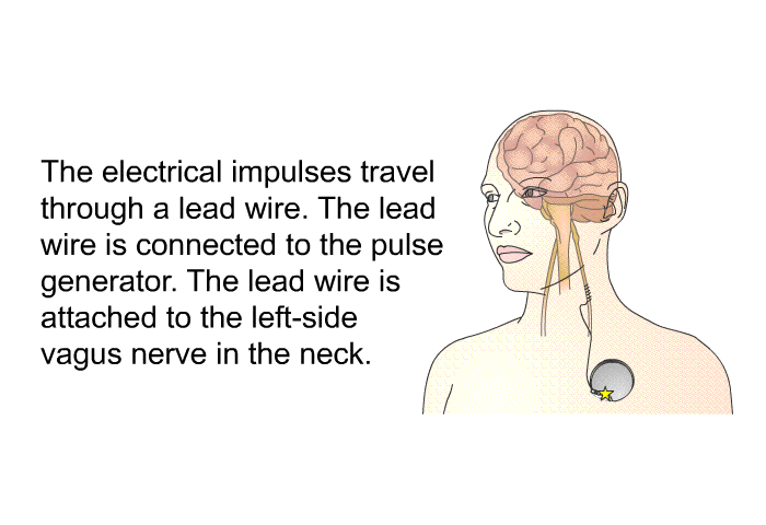 The electrical impulses travel through a lead wire. The lead wire is connected to the pulse generator. The lead wire is attached to the left-side vagus nerve in the neck.