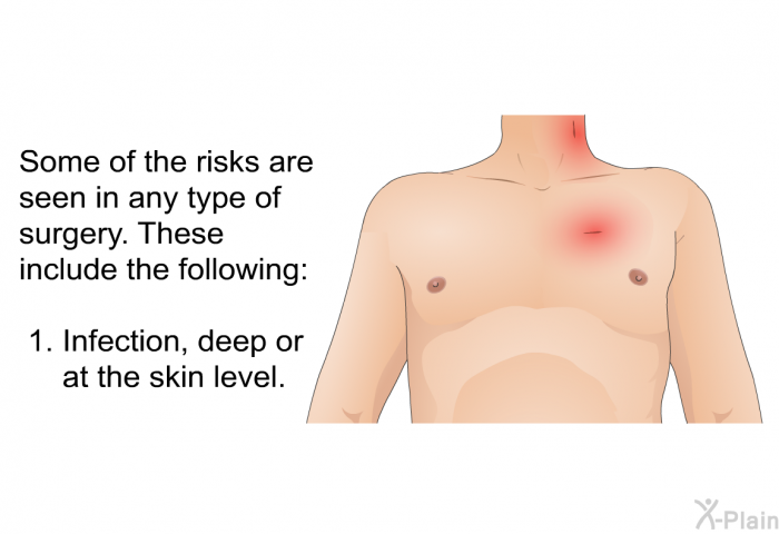 Some of the risks are seen in any type of surgery. These include the following:  Infection, deep or at the skin level.