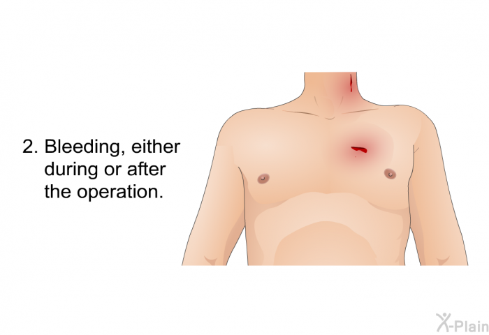 Bleeding, either during or after the operation.
