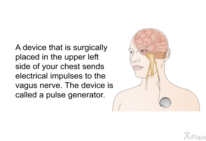 A device that is surgically placed in the upper left side of your chest sends electrical impulses to the vagus nerve. The device is called a pulse generator.