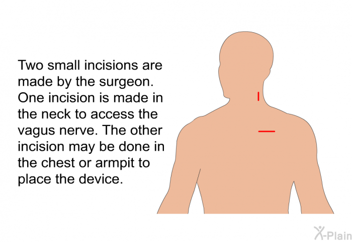Two small incisions are made by the surgeon. One incision is made in the neck to access the vagus nerve. The other incision may be done in the chest or armpit to place the device.