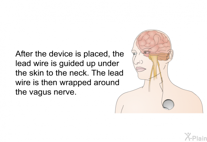 After the device is placed, the lead wire is guided up under the skin to the neck. The lead wire is then wrapped around the vagus nerve.