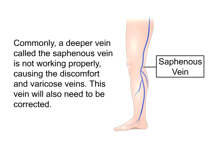 Commonly, a deeper vein called the saphenous vein is not working properly, causing the discomfort and varicose veins. This vein will also need to be corrected.