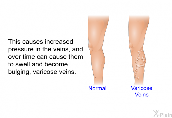 This causes increased pressure in the veins, and over time can cause them to swell and become bulging, varicose veins.