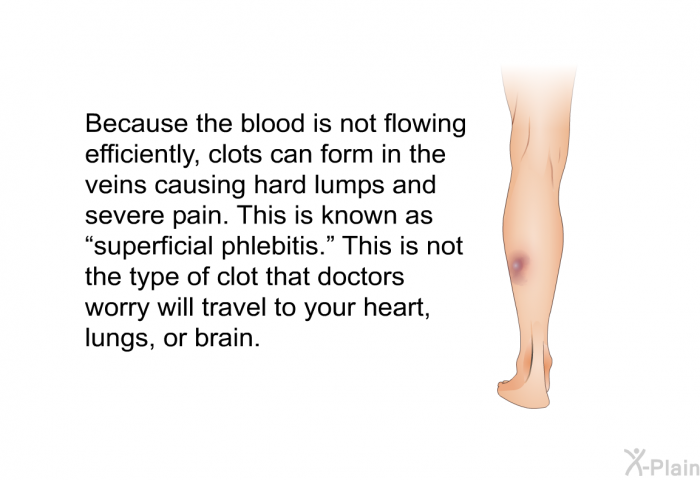 Because the blood is not flowing efficiently, clots can form in the veins causing hard lumps and severe pain. This is known as “superficial phlebitis.” This is not the type of clot that doctors worry will travel to your heart, lungs, or brain.