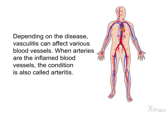 Depending on the disease, vasculitis can affect various blood vessels. When arteries are the inflamed blood vessels, the condition is also called arteritis.