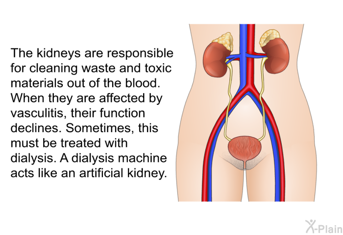The kidneys are responsible for cleaning waste and toxic materials out of the blood. When they are affected by vasculitis, their function declines. Sometimes, this must be treated with dialysis. A dialysis machine acts like an artificial kidney.