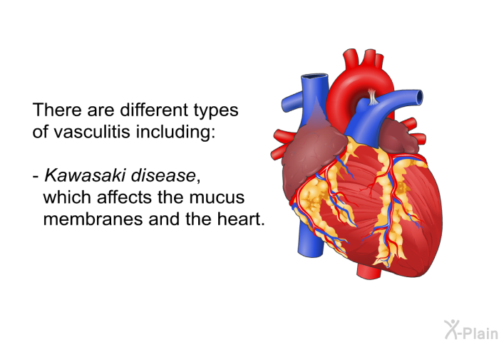 There are different types of vasculitis, including:  Kawasaki disease, which affects the mucus membranes and the heart.
