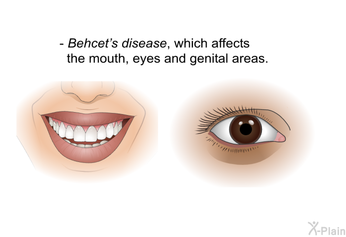 Behcet's disease, which affects the mouth, eyes and genital areas.