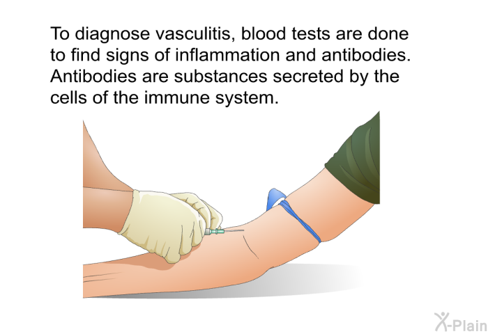 To diagnose vasculitis, blood tests are done to find signs of inflammation and antibodies. Antibodies are substances secreted by the cells of the immune system.