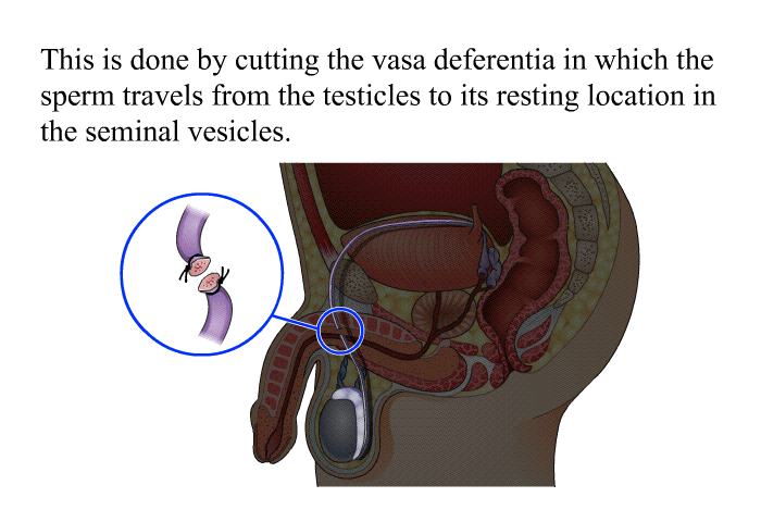 This is done by cutting the vasa deferentia in which the sperm travels from the testicles to its resting location in the seminal vesicles.