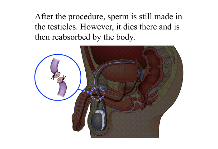 After the procedure, sperm is still made in the testicles. However, it dies there and is then reabsorbed by the body.