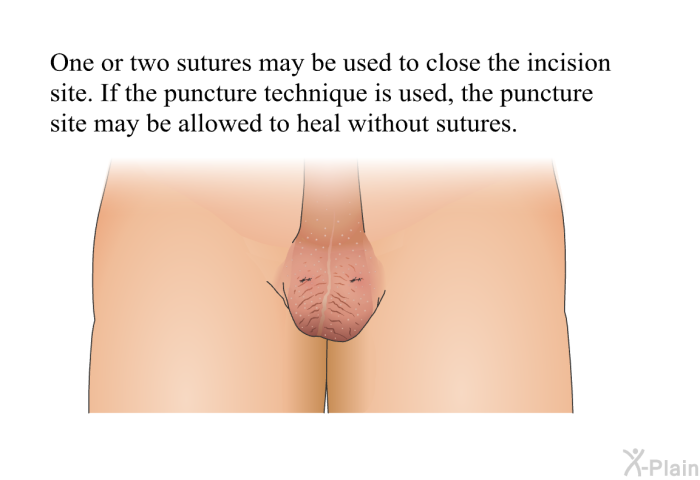 One or two sutures may be used to close the incision site. If the puncture technique is used, the puncture site may be allowed to heal without sutures.
