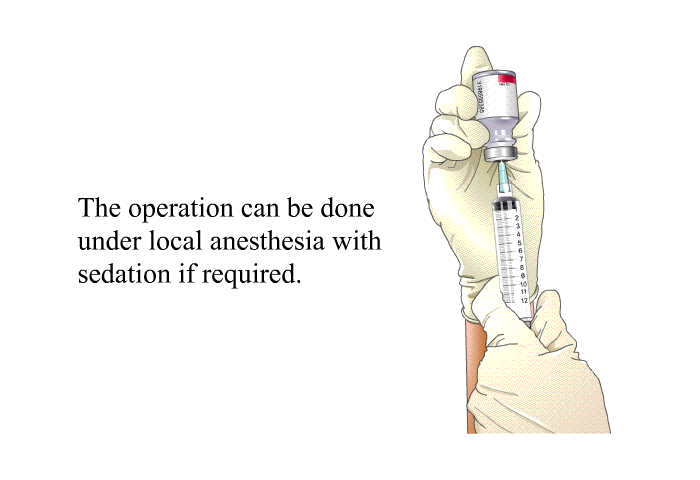 The operation can be done under local anesthesia with sedation if required.