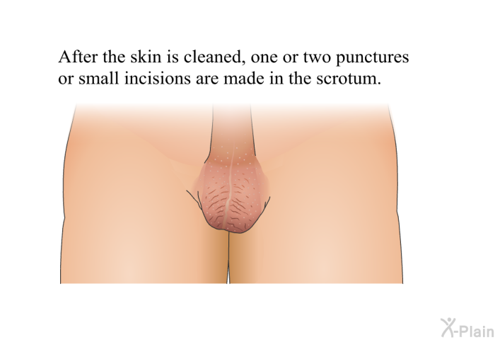 After the skin is cleaned, one or two punctures or small incisions are made in the scrotum.