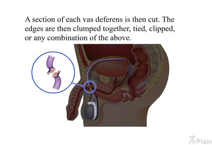 A section of each vas deferens is then cut. The edges are then clumped together, tied, clipped, or any combination of the above.