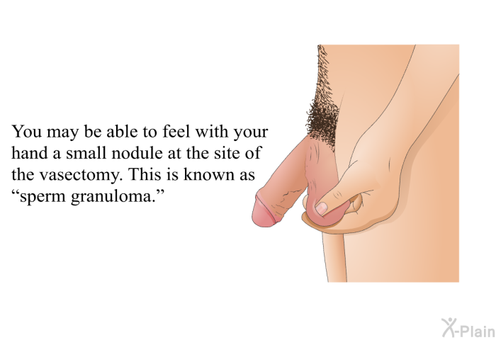 You may be able to feel with your hand a small nodule at the site of the vasectomy. This is known as “sperm granuloma.”